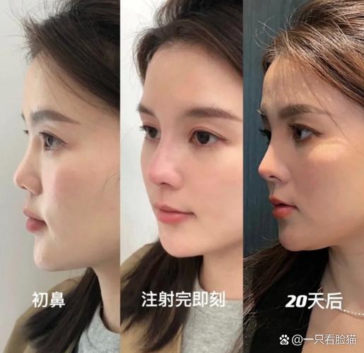 为什么医美拍的照片感觉没有镜子里面的好看
