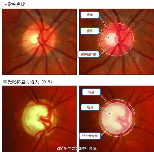 眼底造影检查是怎样的