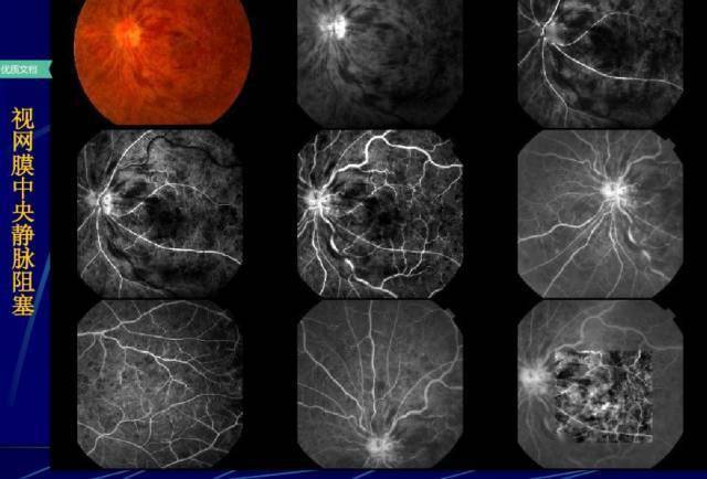 什么是眼部造影