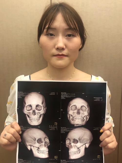 磨颧骨一般多少钱