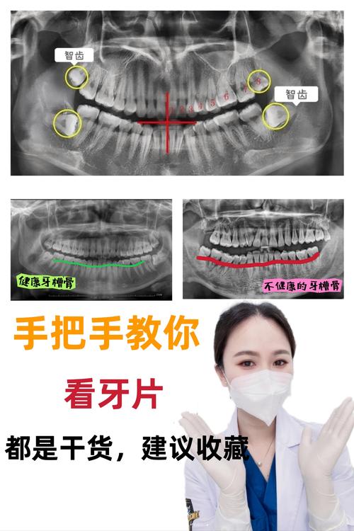 根尖片拍摄角度图解