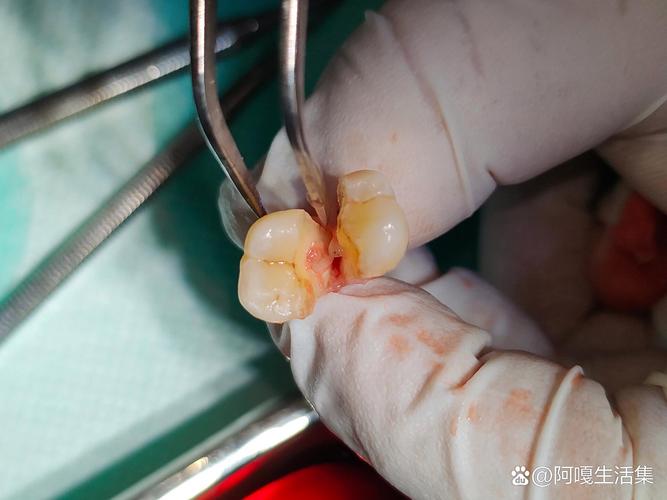 牙劈了一定要拔吗