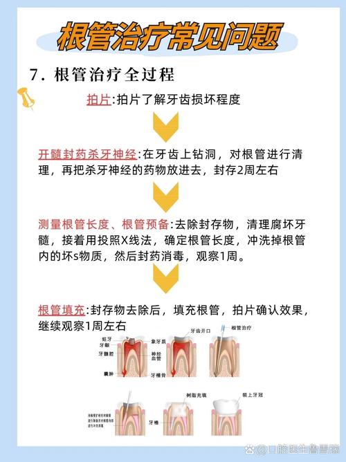 做根管治疗会诱发癌症?根管治疗有哪些风险?