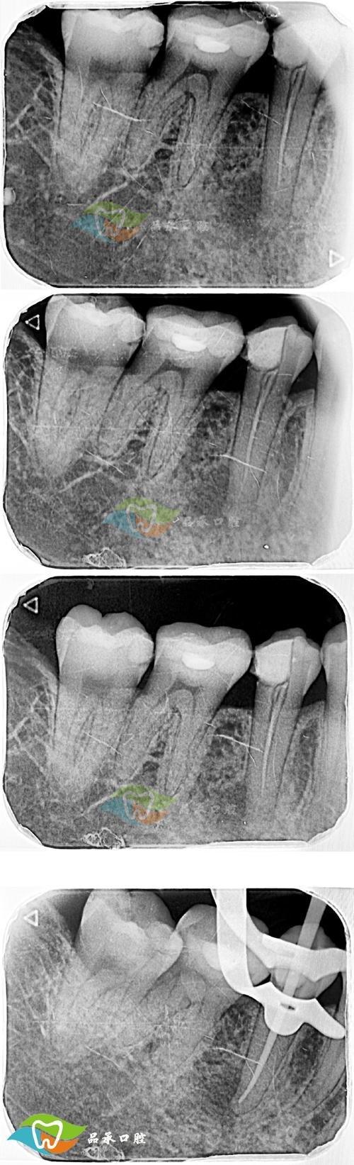 根尖片的拍摄角度图3