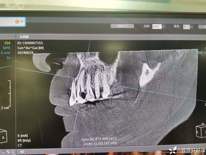 应用最广的根尖片大小是