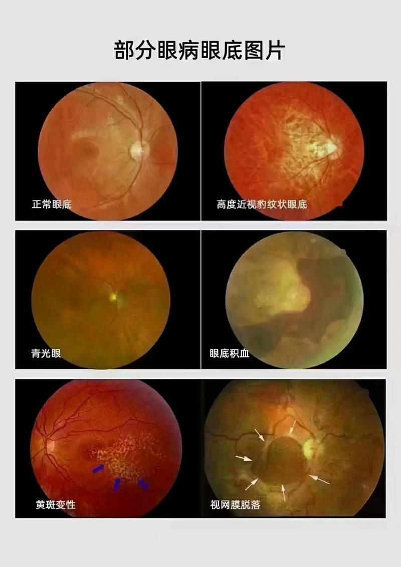 眼底照相机电脑图像软件有哪些图3