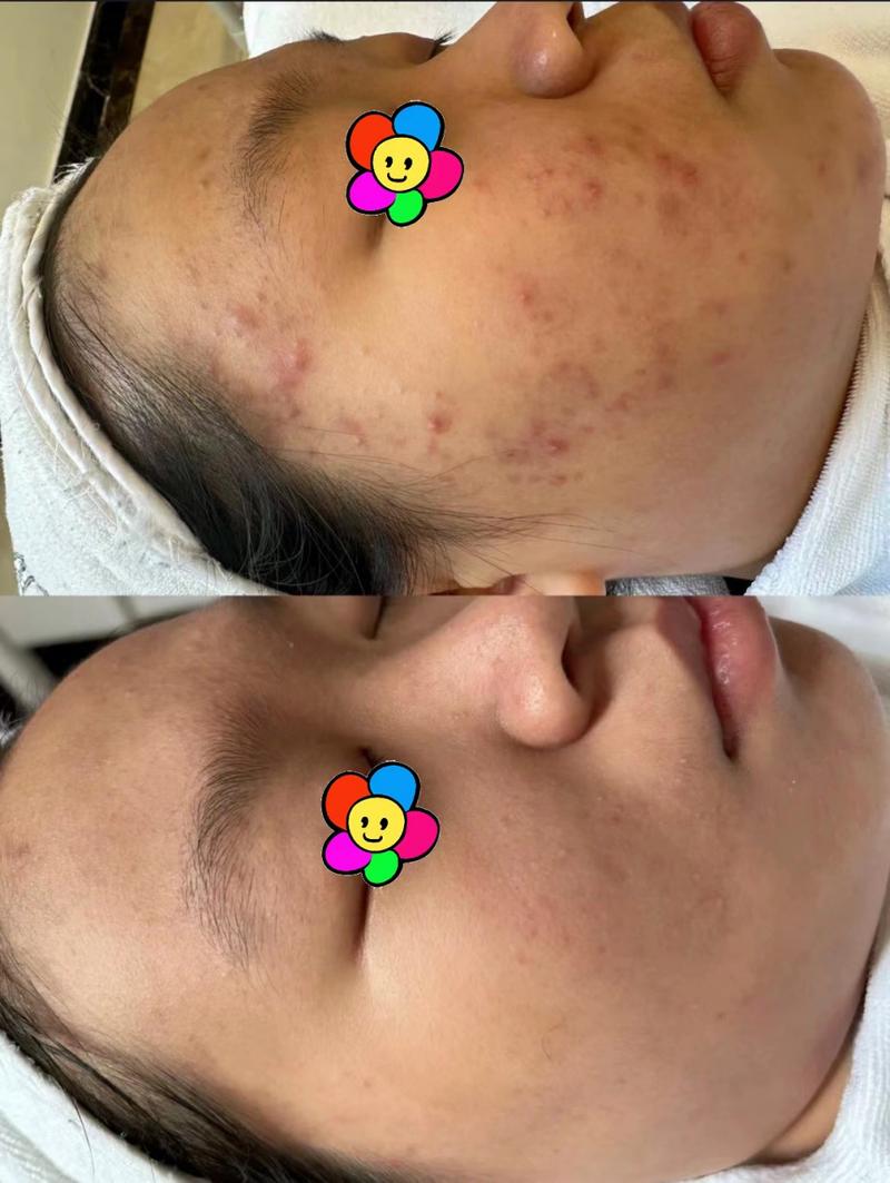 firework8.0怎么才能消除照片中的青春豆呢?